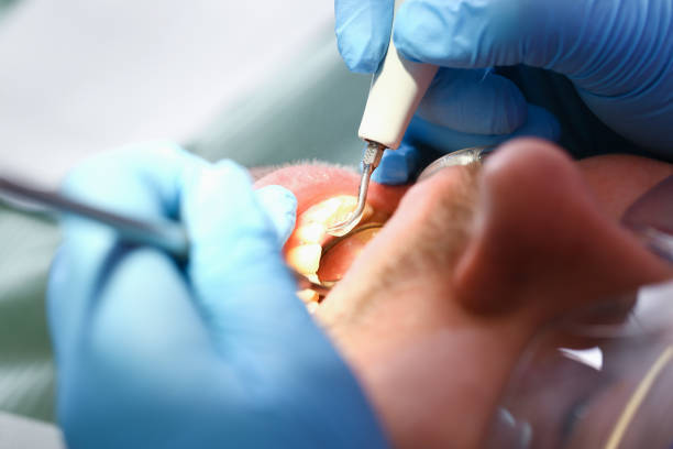 Best Emergency Wisdom Teeth Removal in Gold Canyon, AZ